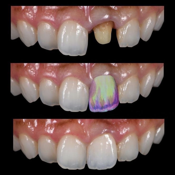 Dental Bridge or Crown