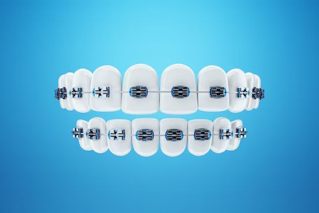 Dental Braces : A Smile transformation journey